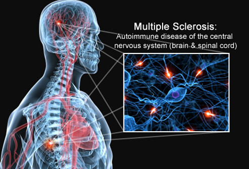 Multiple Sclerosis Symptoms.jpg